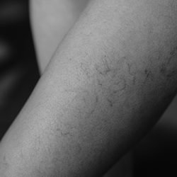 Varicose veins. Vascular diseases. Varicose veins of small vessels on the skin of a woman's thigh. Varicose veins on the woman legs, Vascular, Thrombosis.